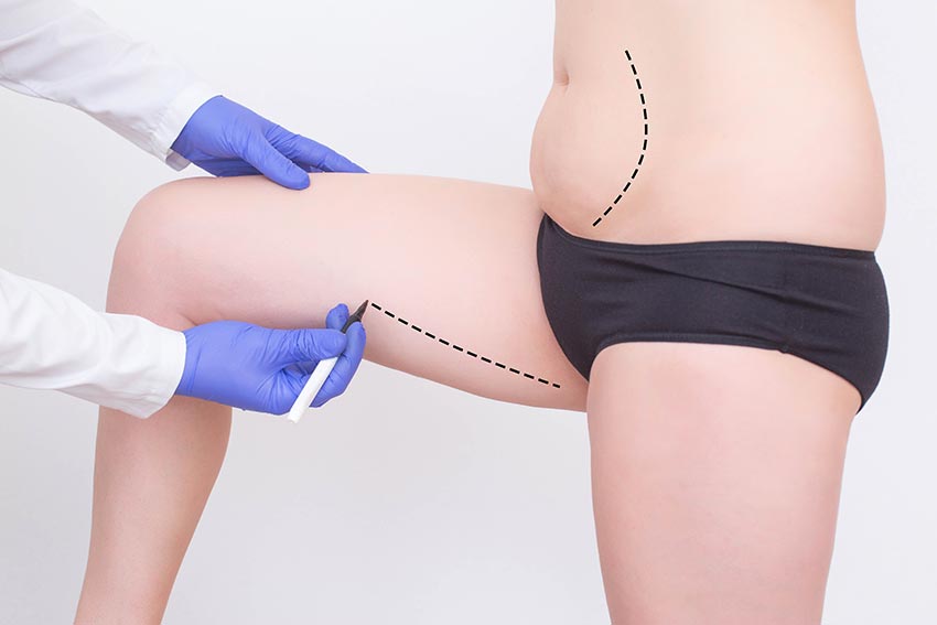Yağ Alma Operasyonu Liposuction Sürecinin Adımları
